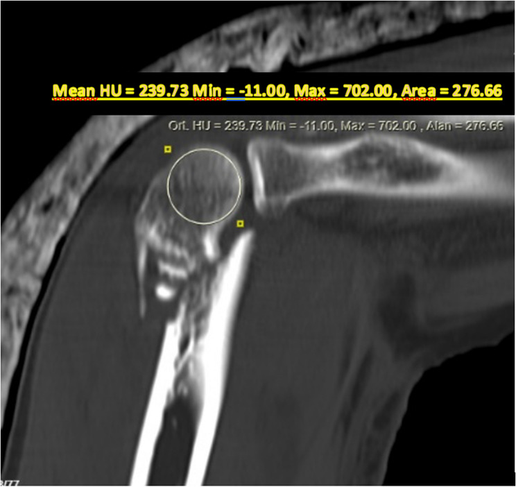Comparison of parallel and orthogonal plating techniques and the predictive role of Hounsfield unit values in AO/OTA type 13-C distal humerus fractures in patients over 50.