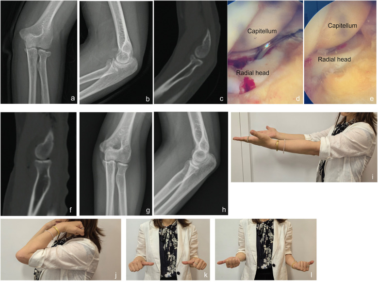 Arthroscopic reduction with non-fixation for Broberg & Morrey type II radial head fracture with mechanical rotation block: a propensity score-matched case-control study.