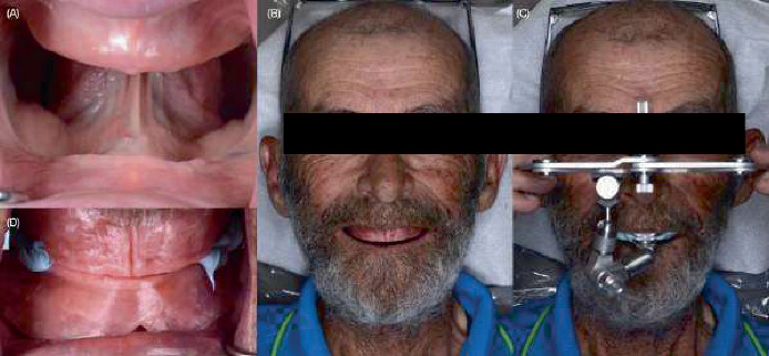 CAD-CAM Complete Dentures Manufactured Using Additive and Subtractive Manufacturing Techniques: A Feasible Clinical Approach for Managing Geriatric Patients With Advanced Residual Ridge Resorption.