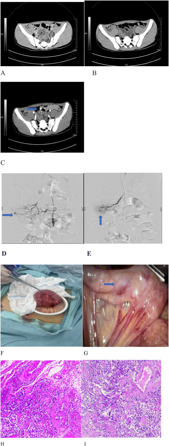 A cavernous hemangioma in the small intestine of a teenage boy: a case report and literature review.