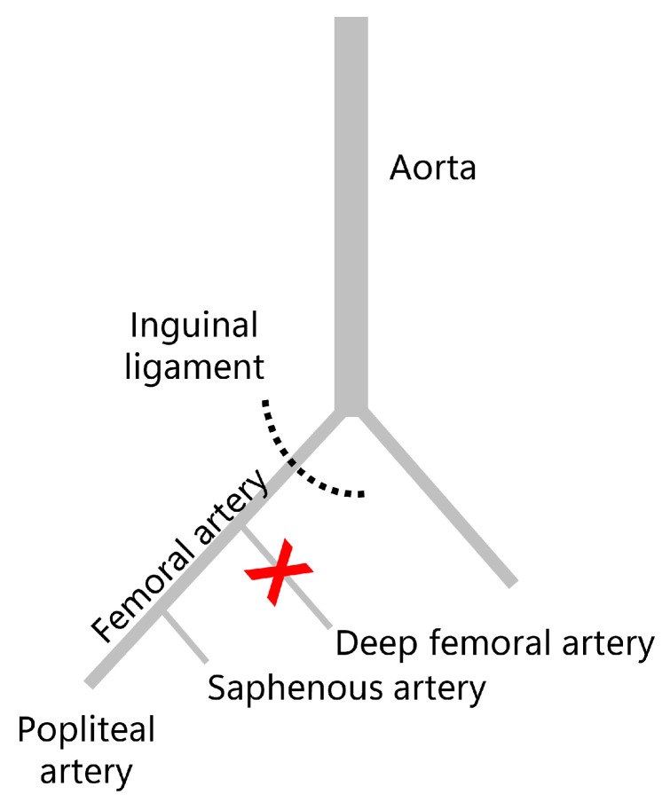 Clopidogrel Influences Fracture Healing Under Ischemic Conditions.