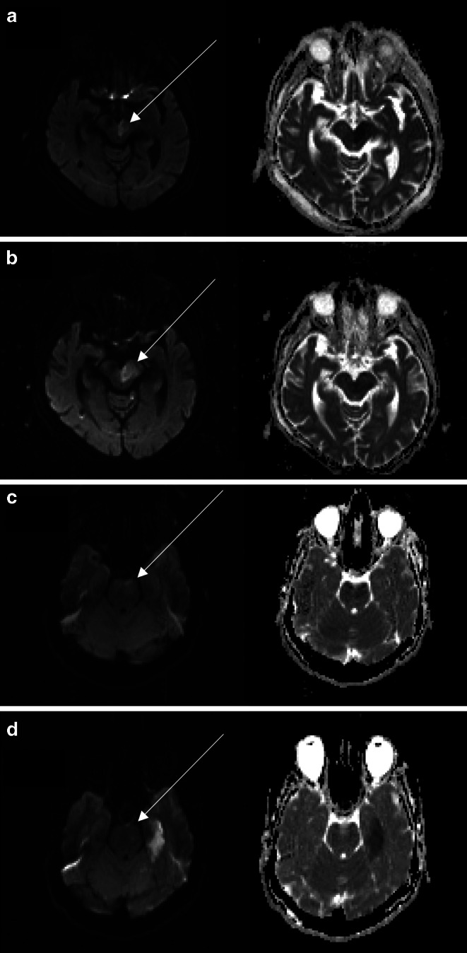 DWI Reversibility in Acute Ischemic Stroke Due to Basilar Artery Occlusion Following Successful Recanalization.