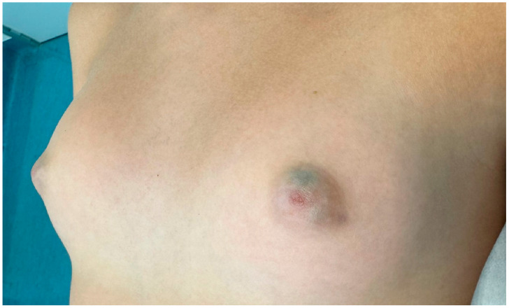 Bluish-Green Coloration of the Nipples: A Diagnostic Clue for Retroareolar Cysts.