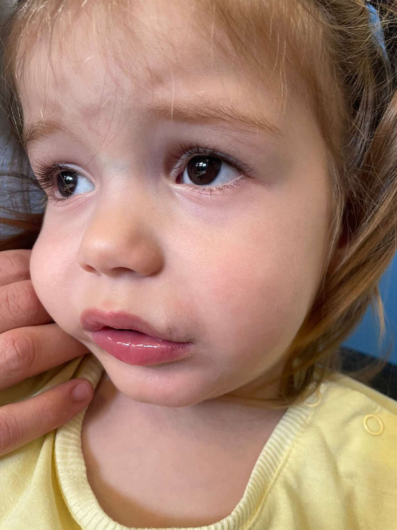 Congenital Lateral Upper Lip Sinus: A Review of the Literature.