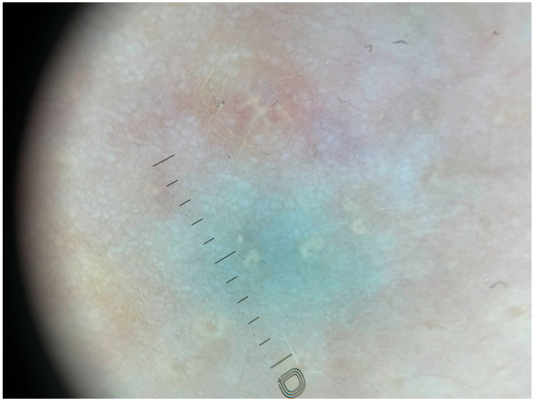 Bluish-Green Coloration of the Nipples: A Diagnostic Clue for Retroareolar Cysts.