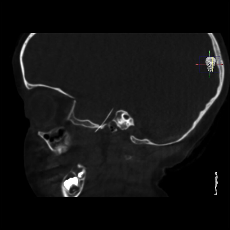 Multidisciplinary management of intracranial migration of a fractured dental needle through the foramen ovale: a case report.