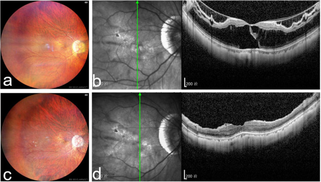 Comparison of the effectiveness of vitrectomy with silicone oil or perfluoropropane tamponade for myopic foveoschisis with foveal detachment.