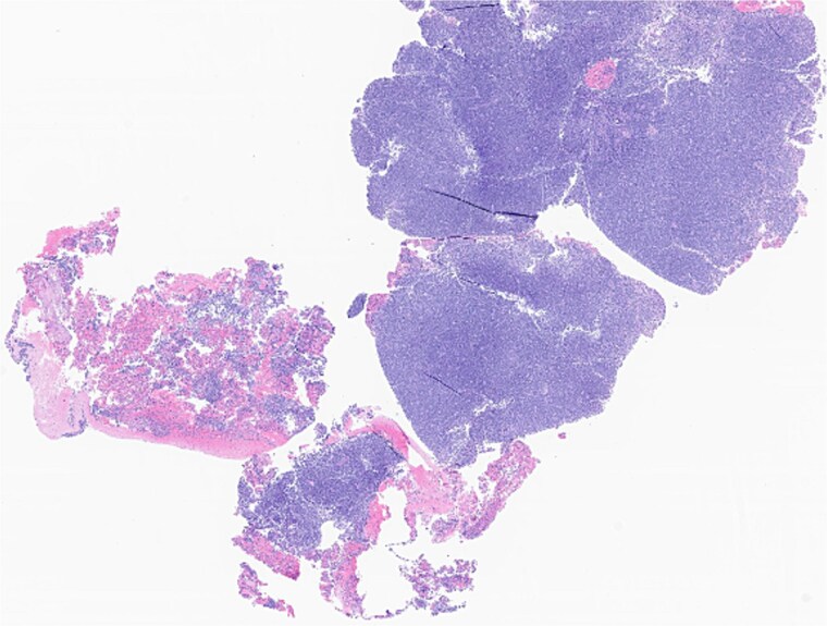 Genomic profiling guided therapy for synchronous SCC and CLL of the parotid gland: a rare case report.