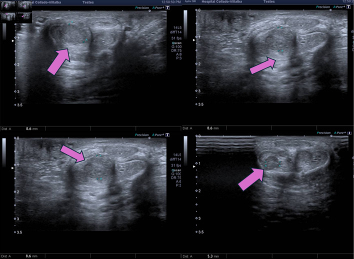 A Forty-Three-Year-Old Male With Penile and Cavernous Metastases From Rectal Cancer.