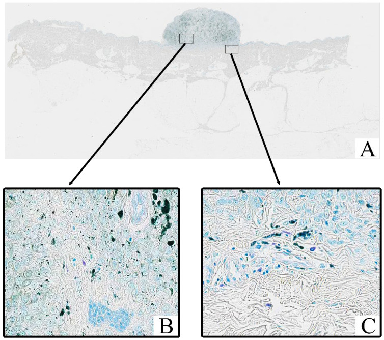 Phenotypic and Quantitative Characterization of Mast Cells in Cutaneous Melanoma: Correlation with Staging Metrics.