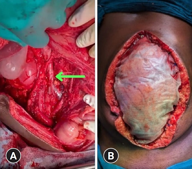 Inferior vena cava injuries at a level I trauma center: a case series.