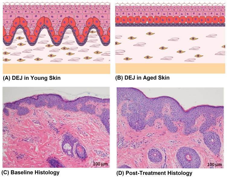 Preliminary Histological Evidence of Epidermal and DEJ Remodeling with Microneedling-Assisted Topical Exosome Therapy: A Single-Subject Case Report.