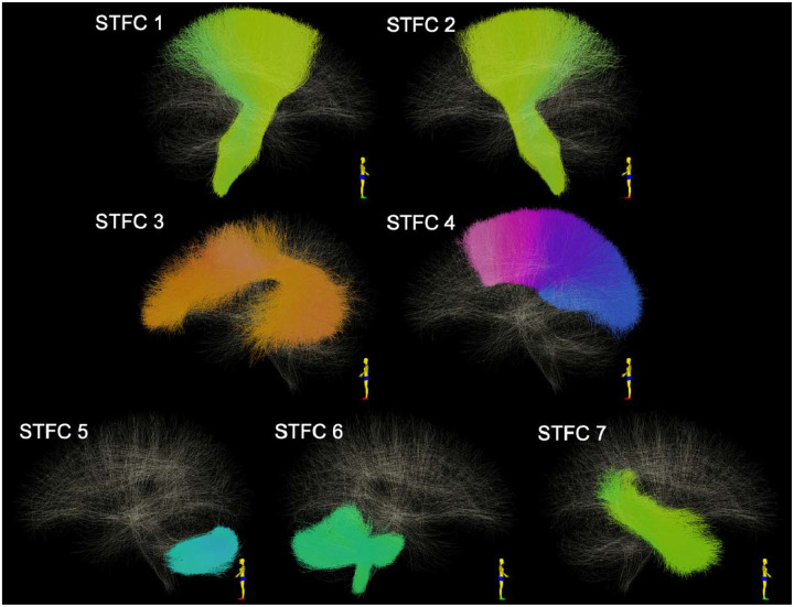 Study of Sex Differences in the Whole Brain White Matter Using Diffusion MRI Tractography and Suprathreshold Fiber Cluster Statistics.