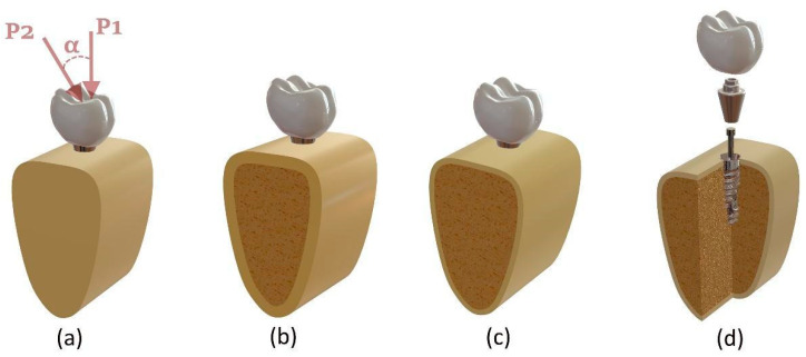 CF-PEEK vs. Titanium Dental Implants: Stress Distribution and Fatigue Performance in Variable Bone Qualities.
