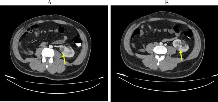 Segmental spleen and left kidney infarction induced by vasoconstriction in a methamphetamine abuser patient: a case report.