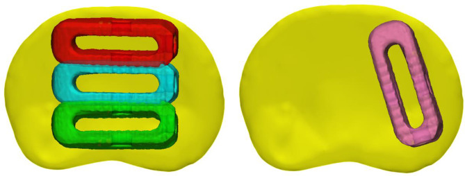 A pipeline to morph finite element models of the lumbar spine for generation of customised spinal cages.