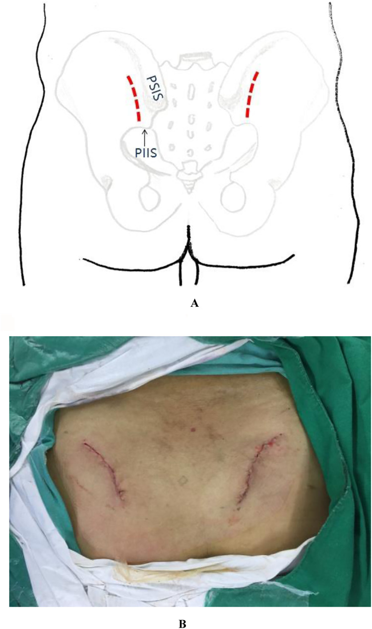 Posterior pelvic ring fixation: evolution of surgical approaches and evidence-based outcomes for unstable fractures.