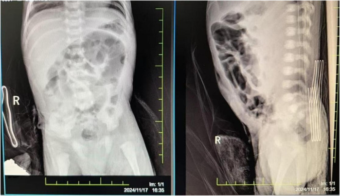 Prolonged resuscitation and systemic management of multi-organ dysfunction in a neonate with severe asphyxia: a case report.