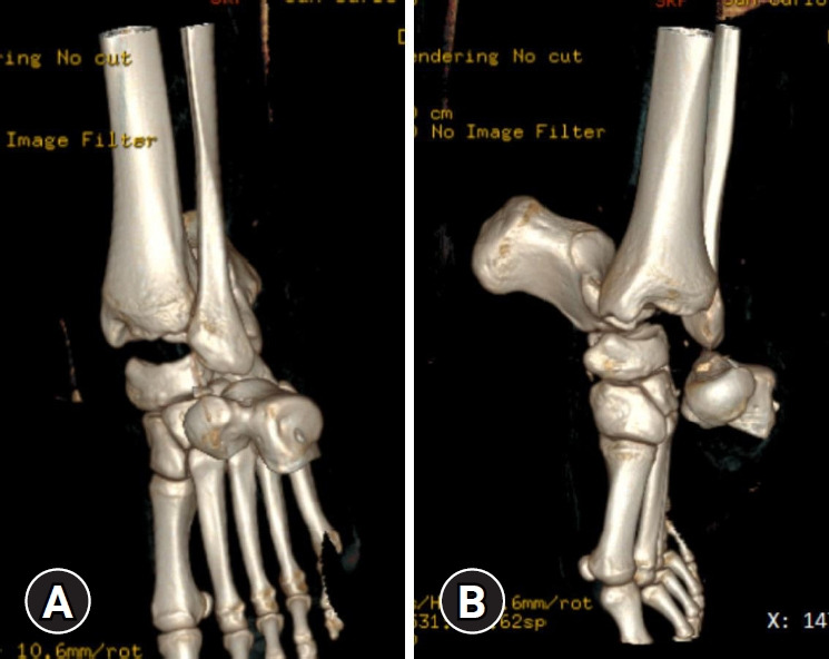 Open total talar dislocation treated with reimplantation of the talus and reverse adipofascial sural flap: a case report.