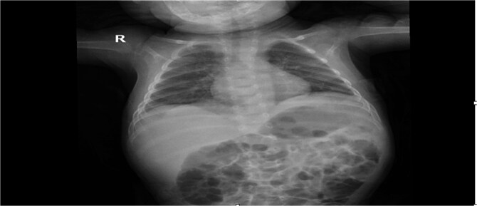 Tension gastrothorax in a late-presenting congenital diaphragmatic hernia: a case report and review of the literature.