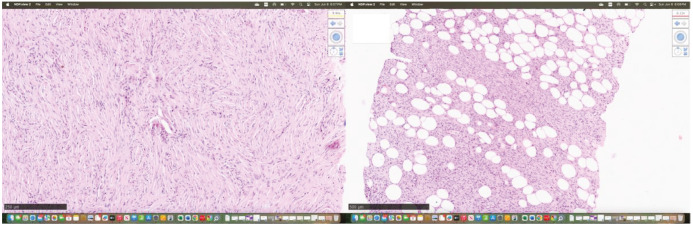 Dermatofibrosarcoma Protuberans of the Breast.