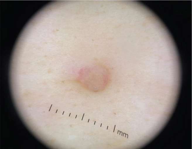 Multiple Papules and Nodules in a Dermatomal Distribution: A Quiz.