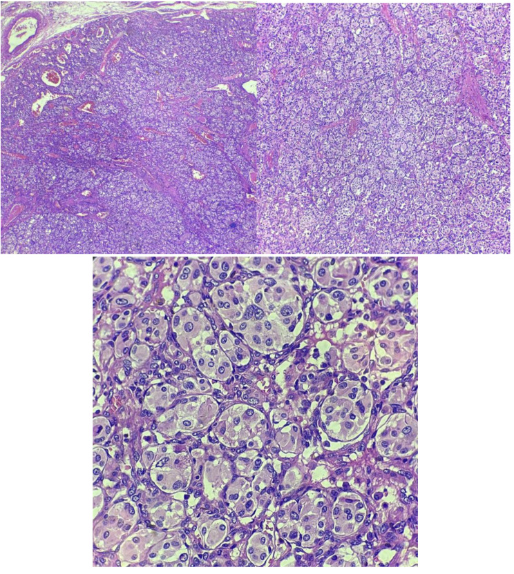 Multiple paragangliomas diagnosed in head, neck, and mediastinum: a case report.