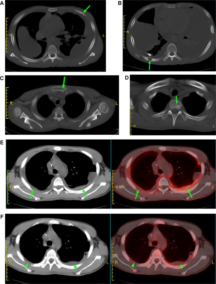Chylothorax-induced diaphragmatic herniation: a novel complication of Gorham-Stout syndrome.