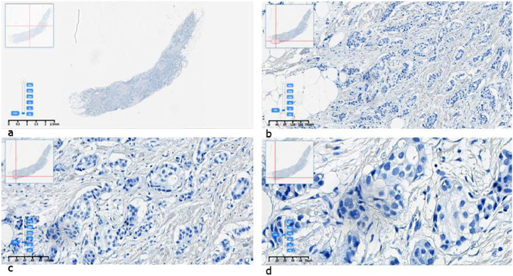Kazakhstani HER2 breast cancer digital image dataset: The ADEL dataset.