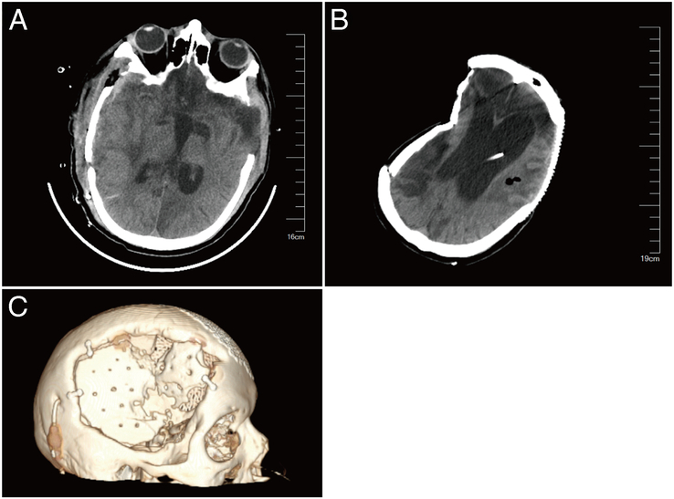 Comparative Study of Computer-Aided Designed PEEK Implants Versus Autologous Bone Flap in Cranioplasty: Clinical Efficacy and Medical Economics Analysis.