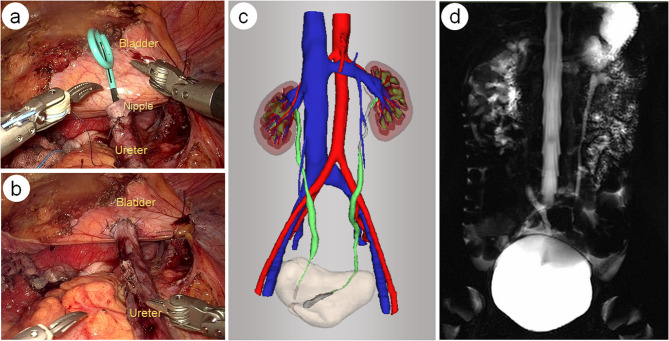 Robot-assisted ureteral reimplantation using the KangDuo surgical Robot-01 system: a prospective, single-center, single-arm pilot study.