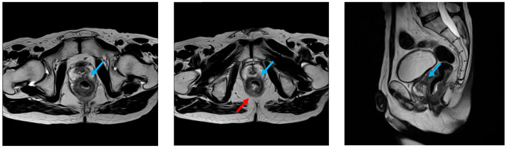 Robotic-Assisted Total Pelvic Exenteration for Rectal Cancer Using the Hugo™ RAS System: First Case Report.