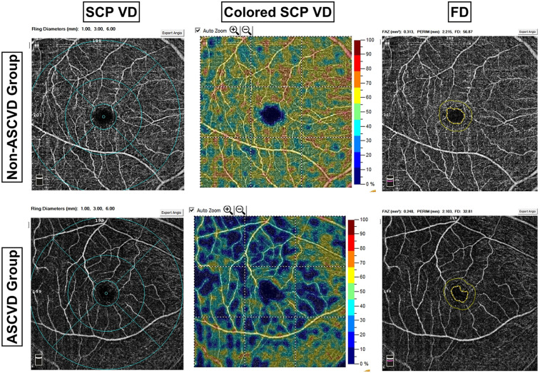 Retinal vascular alterations as assessment indicators of atherosclerotic cardiovascular disease risk in dyslipidemia patients.