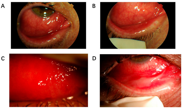 Influenza-Associated Ocular Complications: A Comprehensive Review of Viral Subtypes, Clinical Presentations, and Vaccination Risks.