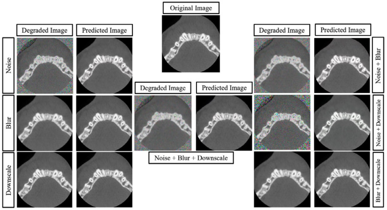 Deep learning for dentomaxillofacial cone-beam computed tomography image quality enhancement: A pilot study.