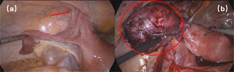 Adenomyoma of the round ligament of the uterus in the inguinal canal: a case report.