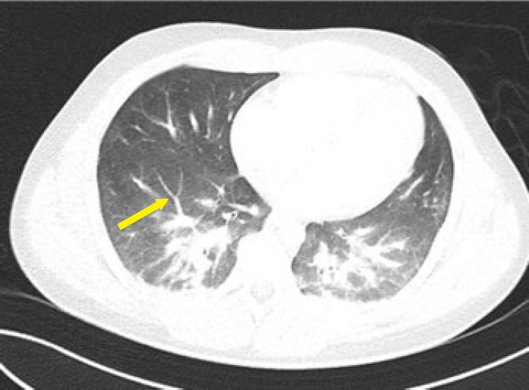 Fatal fat embolism syndrome in a young trauma patient with a stable initial presentation: time to define predictive criteria? A case report.