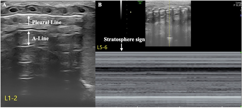 Case Report: Air-fluid point: a specific ultrasound sign for the diagnosis of hydropneumothorax in newborn infants.