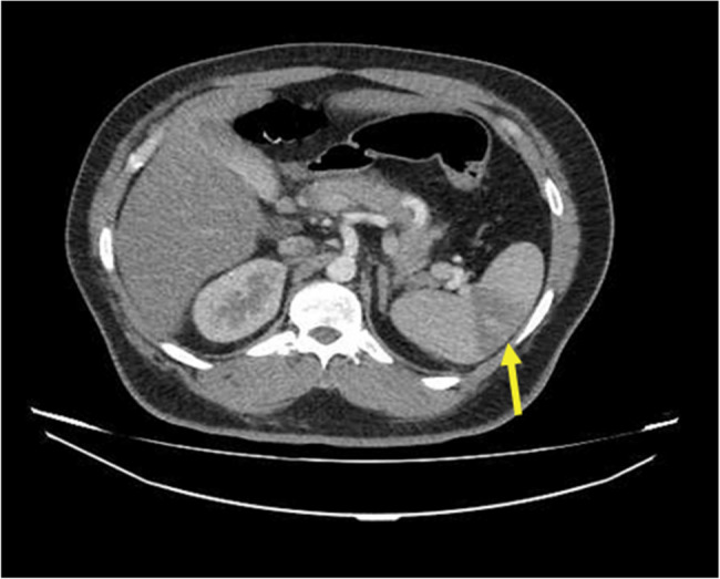 Segmental spleen and left kidney infarction induced by vasoconstriction in a methamphetamine abuser patient: a case report.