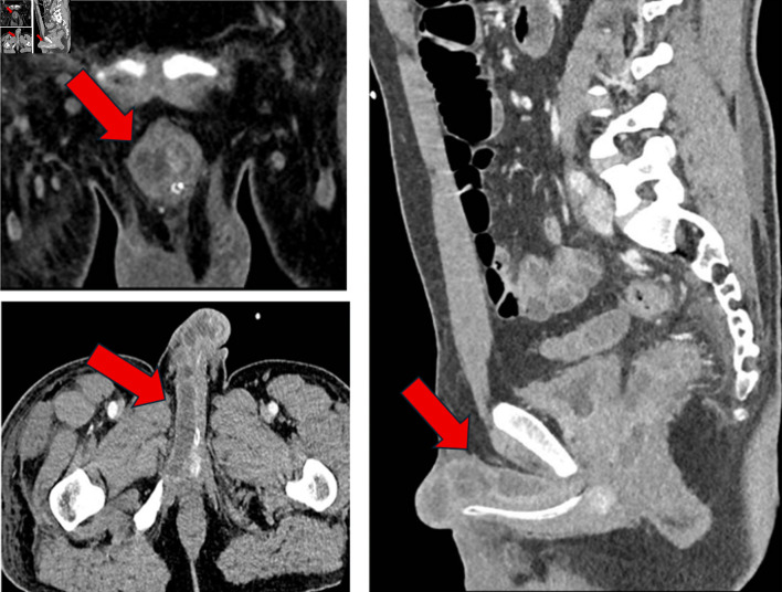 A Forty-Three-Year-Old Male With Penile and Cavernous Metastases From Rectal Cancer.