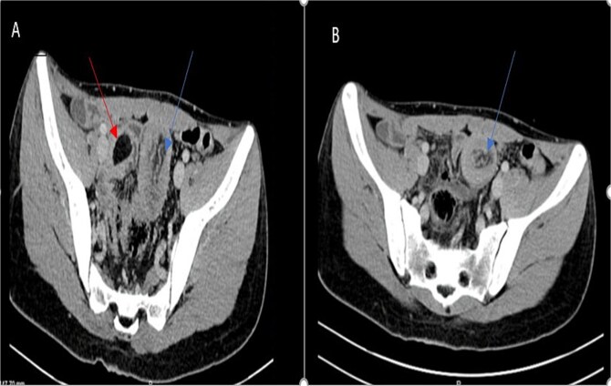 Jejunal lipoma presenting as small bowel intussusception in an adult: diagnostic and surgical challenges-a case report.
