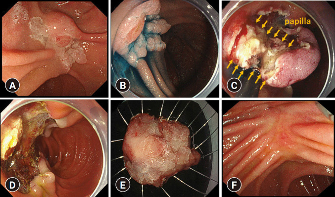 Efficacy and safety of endoscopic submucosal dissection versus endoscopic papillectomy for managing laterally spreading duodenal papillary tumors.