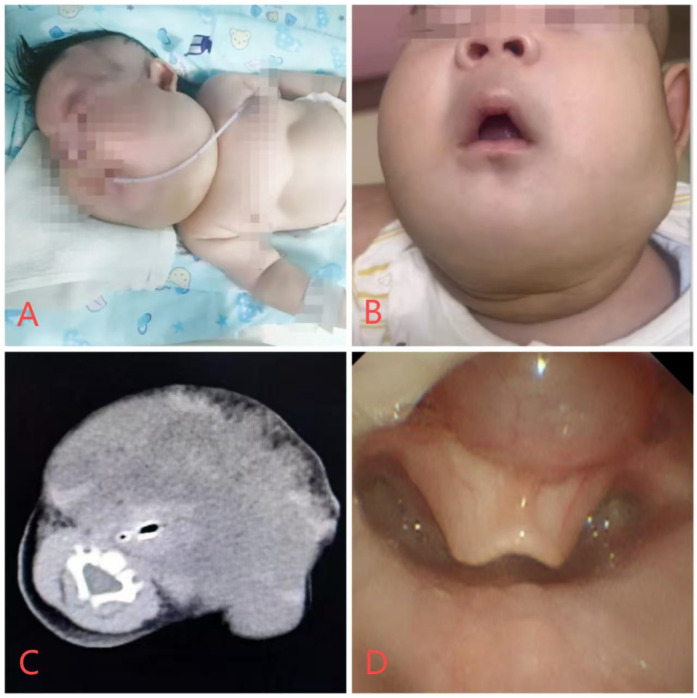 Multidisciplinary management of extensive cervical lymphatic malformations and epiglottic cyst in a neonate: a case report and review of perioperative strategies.