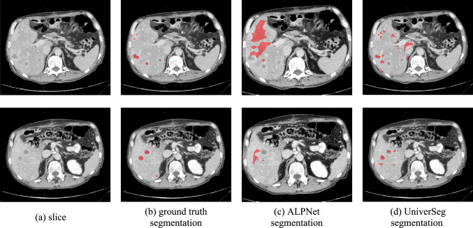 Streamlining the annotation process by radiologists of volumetric medical images with few-shot learning.