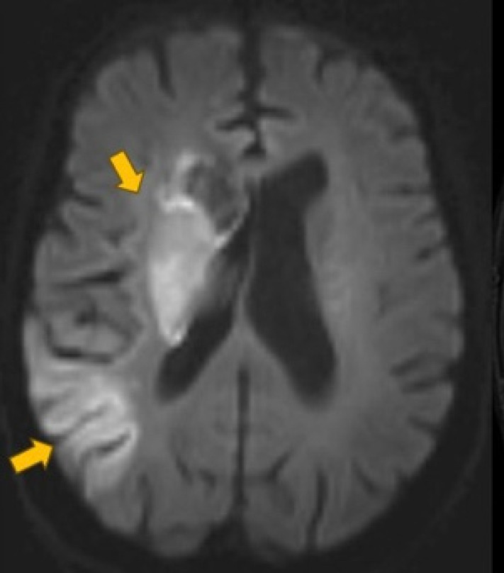 Navigating severe vascular tortuosity and cervical carotid loop management in stroke thrombectomy: A case report and review of the literature.