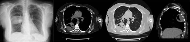 Thoracic ultrasonography in the diagnosis and follow-up of lung abscess.