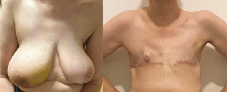 Air-Assisted Mastectomy Using LigaSure for a Breast Cancer Patient With a Cardiac Pacemaker.
