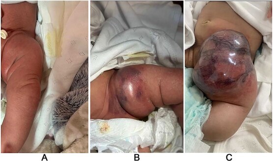 Is it a hemangioma? A combined case report of soft tissue sarcomas mimicking infantile hemangioma.