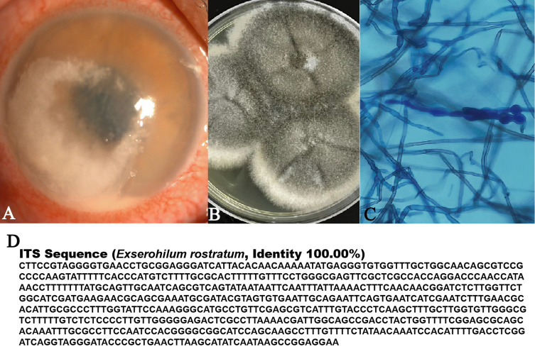 <i>Achaetomium luteum</i> and <i>Exserohilum rostratum</i>, Two Rare Causes of Keratomycosis in China: Case Report.