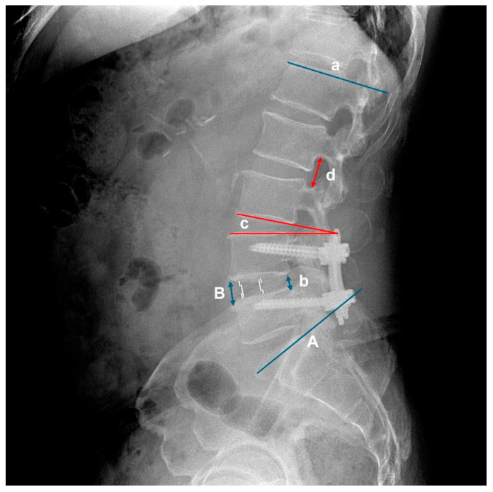 Radiographic Analysis of Early Changes in Upper Adjacent Segments After Fusion Surgery: OLIF vs. PLIF.